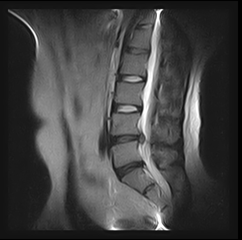 herniated disk xray